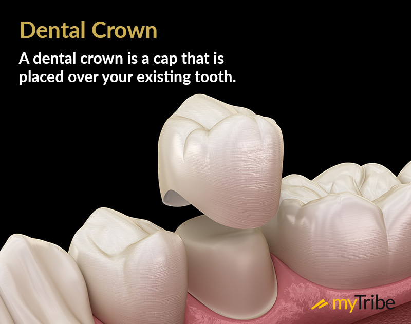 Veneers Vs. Crowns Pros And Cons And Costs (2024 Guide)